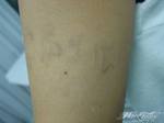 mark-tattoo-torrejon-ardoz-tatuaje-laser-eliminar